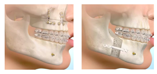 orthodontic surgery x-ray images