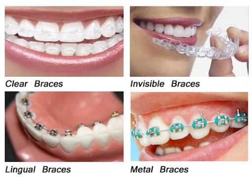 different kinds of braces