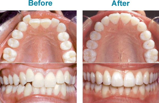 invisalign before and after pictures