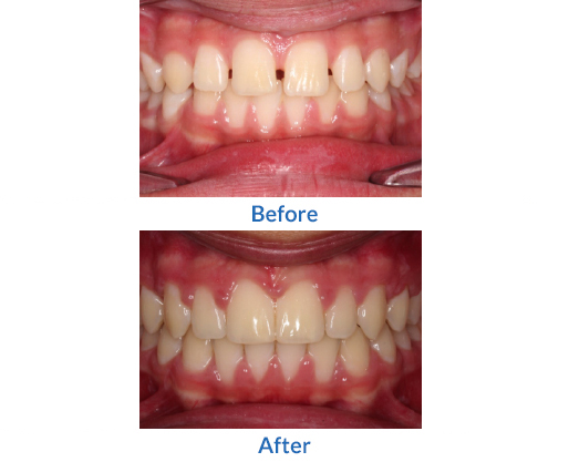 Crooked teeth before and after image 3