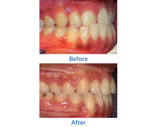 Crooked teeth before and after image 4
