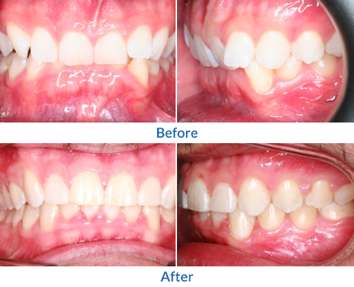 Crooked teeth before and after image 5