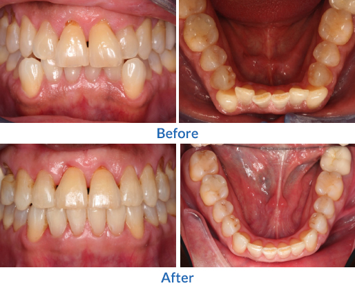 Crooked teeth before and after image 6