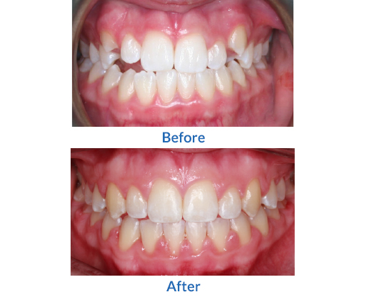 Another example of before and after braces 1