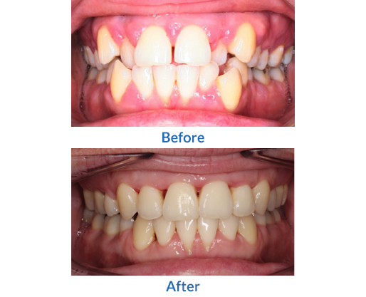 Crooked teeth before and after image