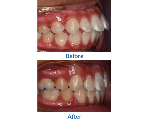 Crooked teeth before and after image 1