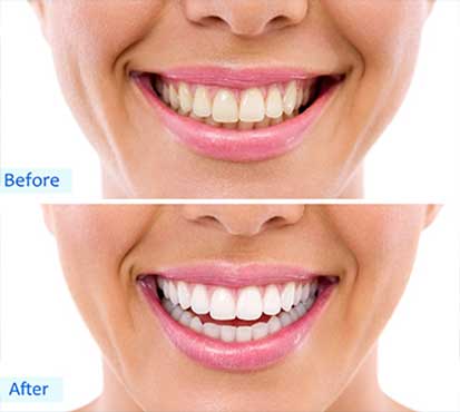 Braces Las Vegas Teeth Whitening